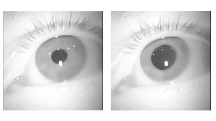 Nærbilde av øyer med synlig forskjell i størrelsen på pupillen.